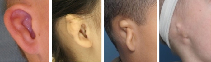Malformed external ear
