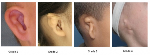 goldenhar syndrome ear