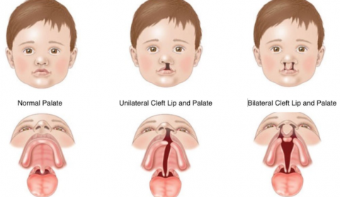 Oral Cleft