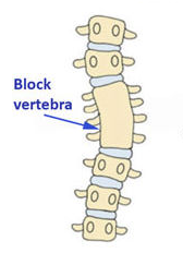 Block vertebrae
